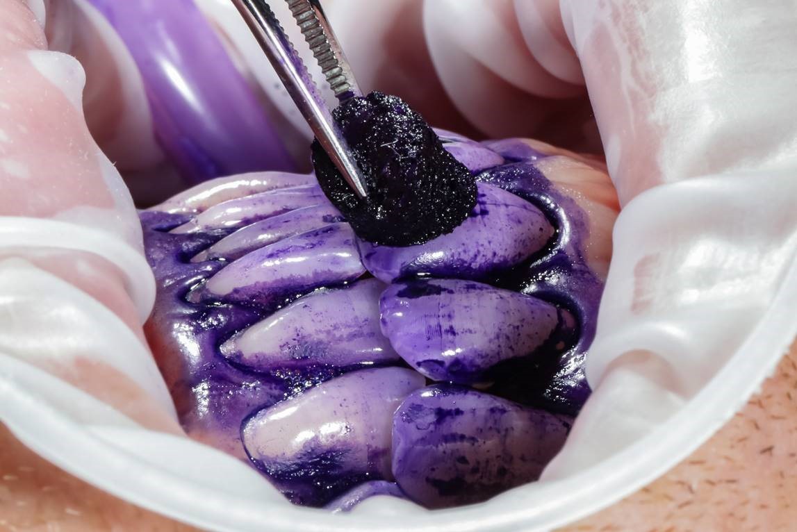 Violetinis dažiklis išryškina apnašas ant dantų