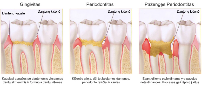 Gingivito, periodontito ir pažengusio periodontito palyginimo schema